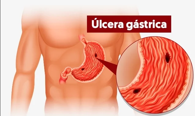 misoprostol para tratar ulceras misoprostol para tratar ulceras