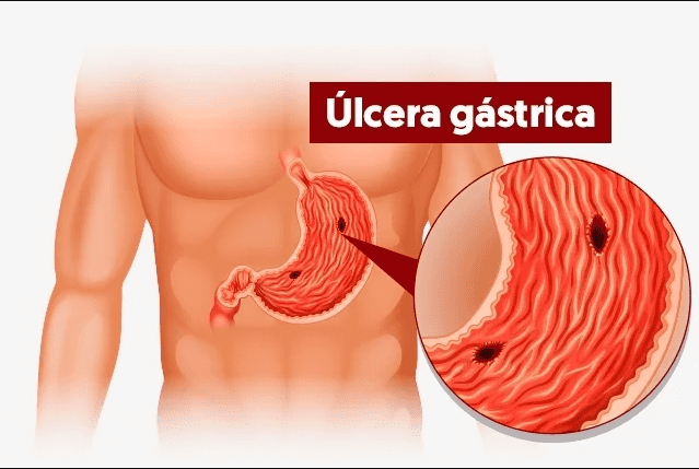 Tratamento de úlceras com misoprostol e outros tipos