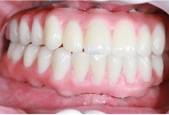 dente falso